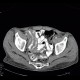 Acute enterocolitis, enteritis and colitis: CT - Computed tomography